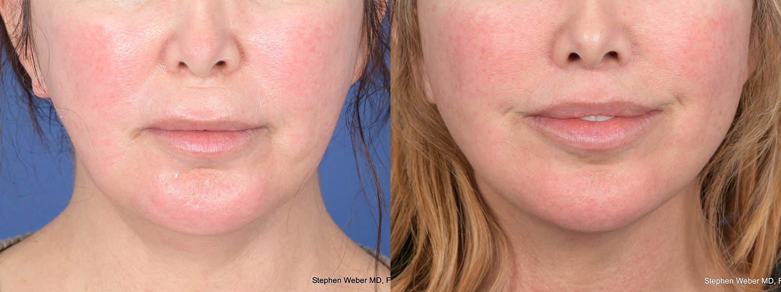 Buccal Fat Pad Removal Before and After | Weber Facial Plastic Surgery