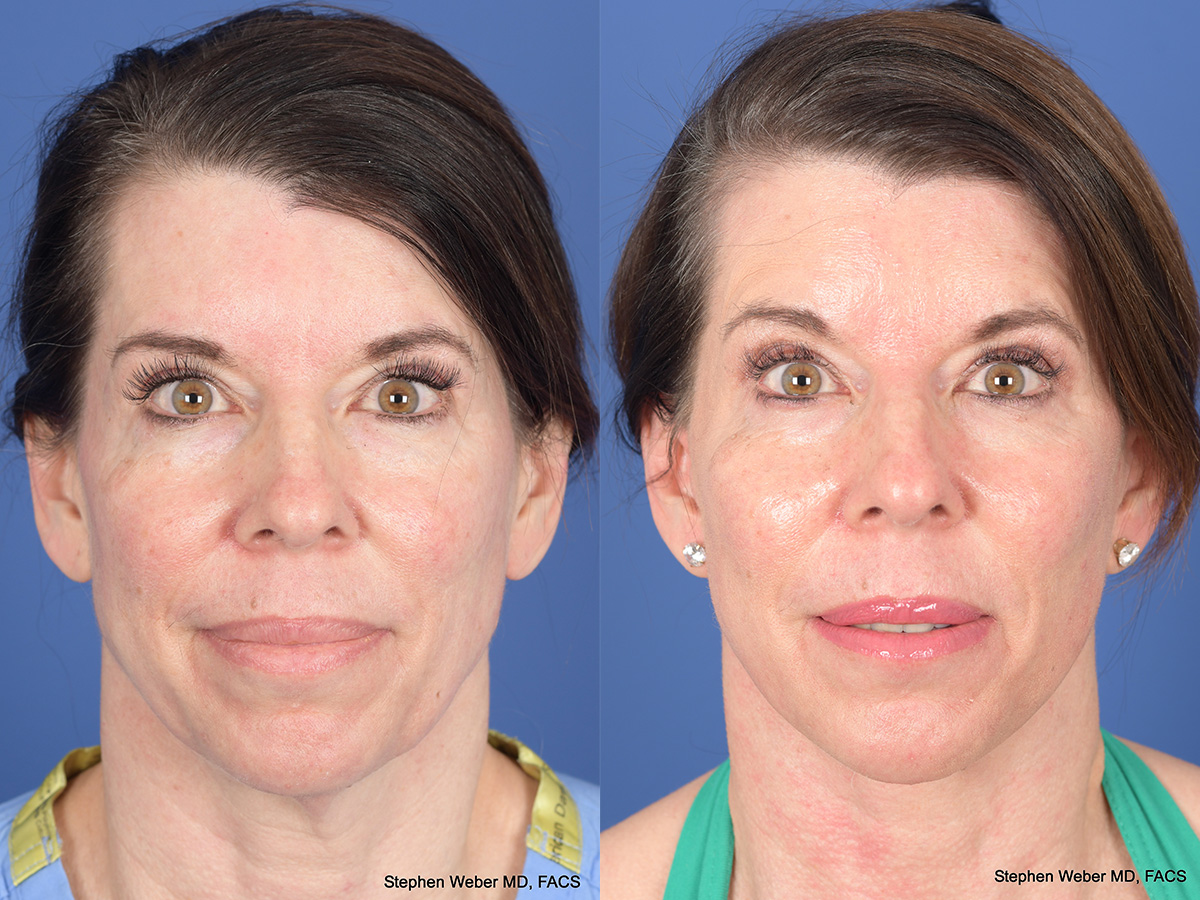 Cheek Implant Before and After | Weber Facial Plastic Surgery