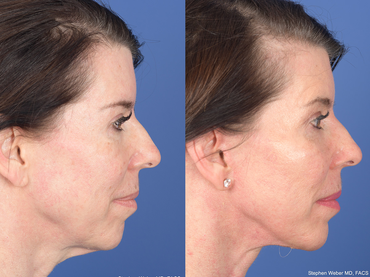 Cheek Implant Before and After | Weber Facial Plastic Surgery
