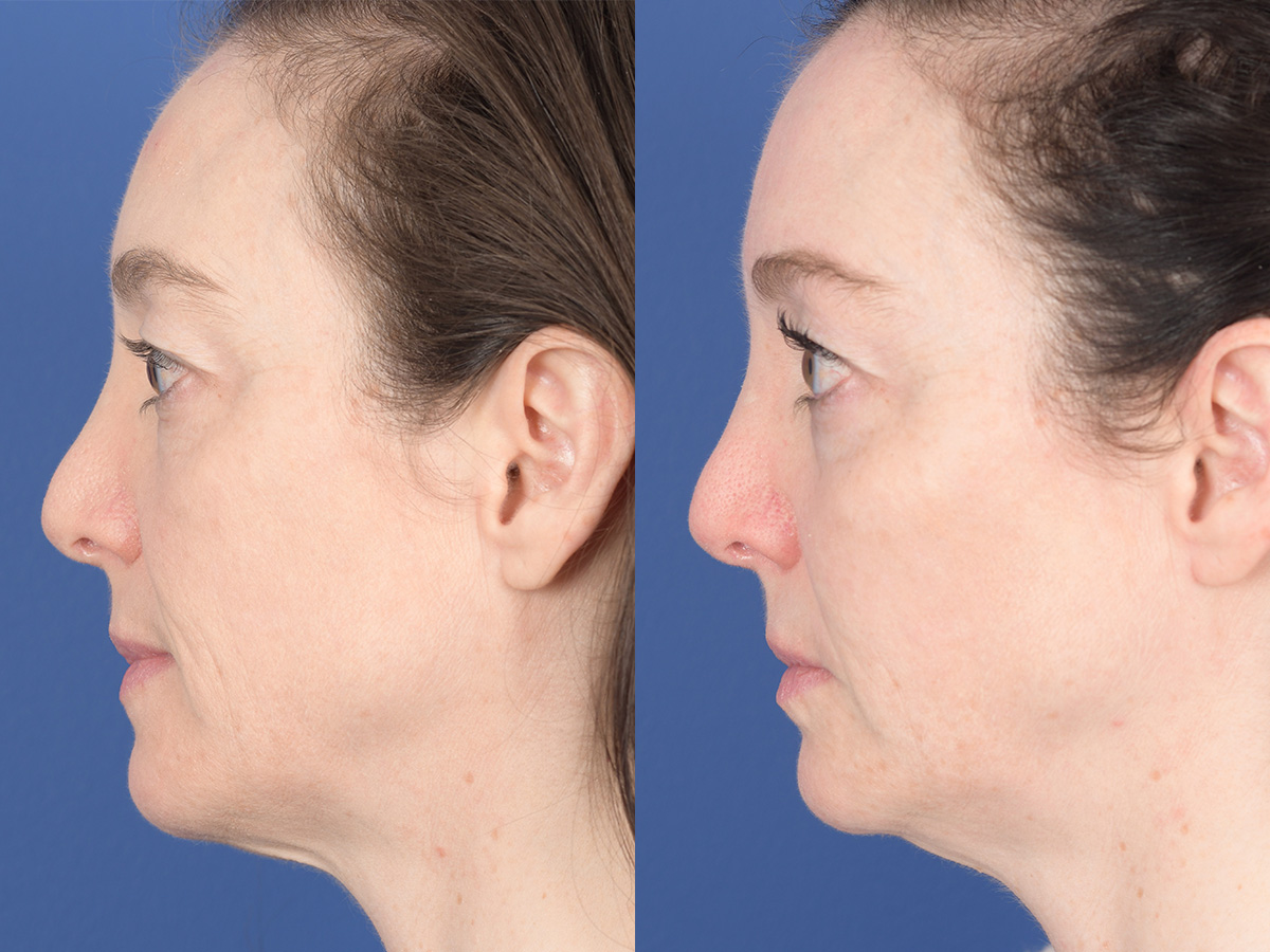 Cheek Implant Before and After | Weber Facial Plastic Surgery