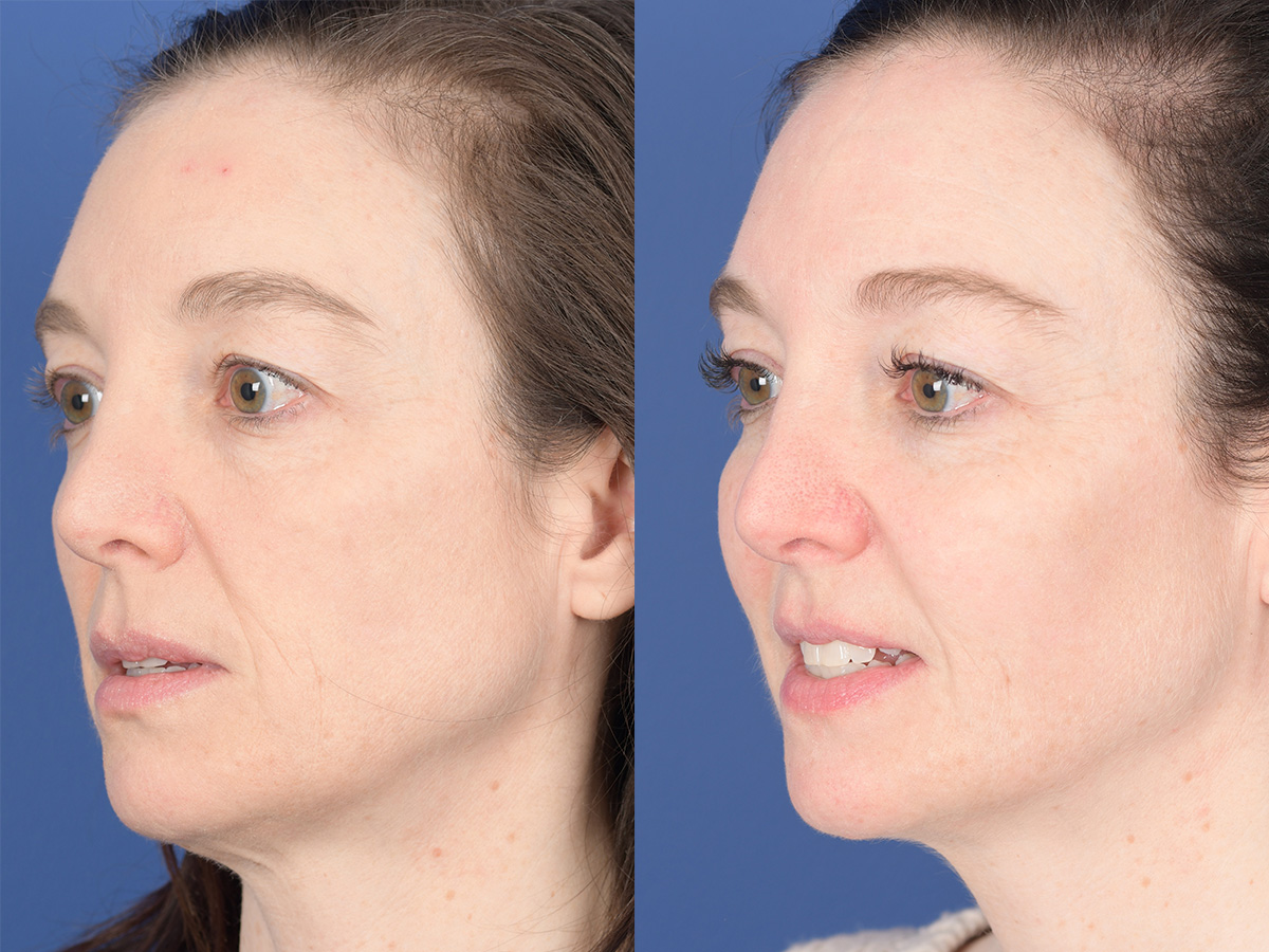 Cheek Implant Before and After | Weber Facial Plastic Surgery