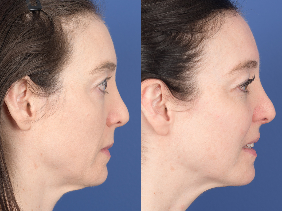 Cheek Implant Before and After | Weber Facial Plastic Surgery