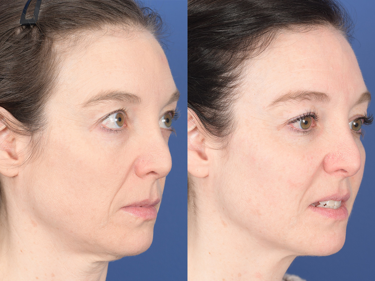 Cheek Implant Before and After | Weber Facial Plastic Surgery