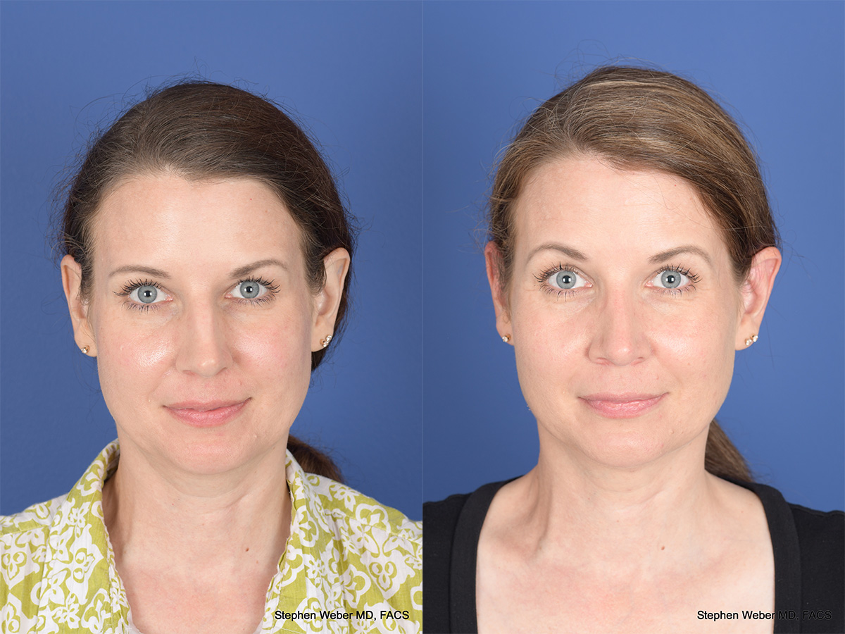 Cheek Implant Before and After | Weber Facial Plastic Surgery