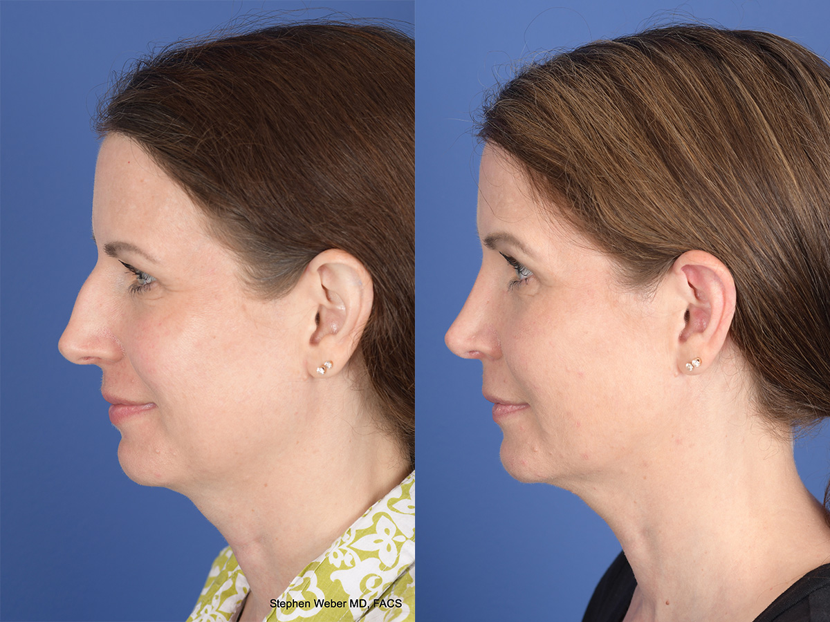 Cheek Implant Before and After | Weber Facial Plastic Surgery