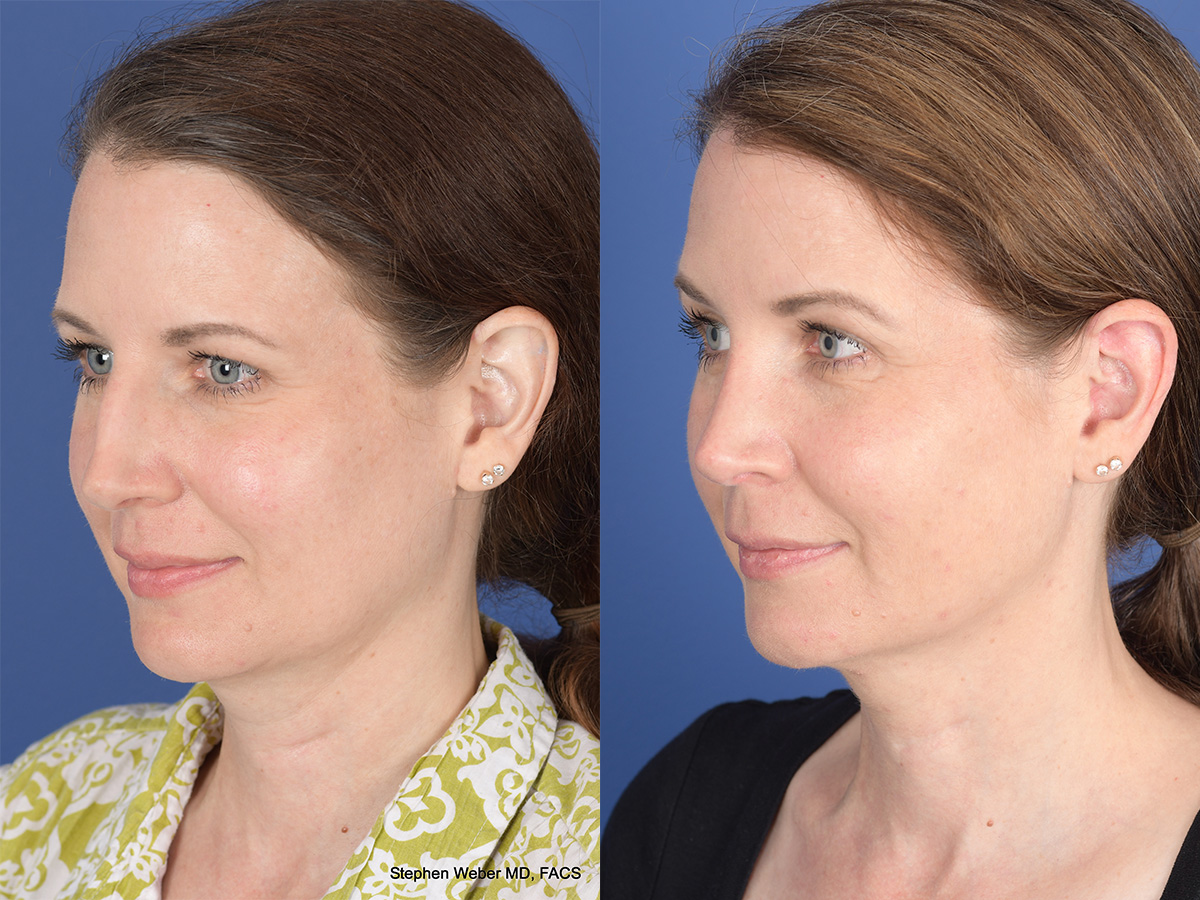 Cheek Implant Before and After | Weber Facial Plastic Surgery