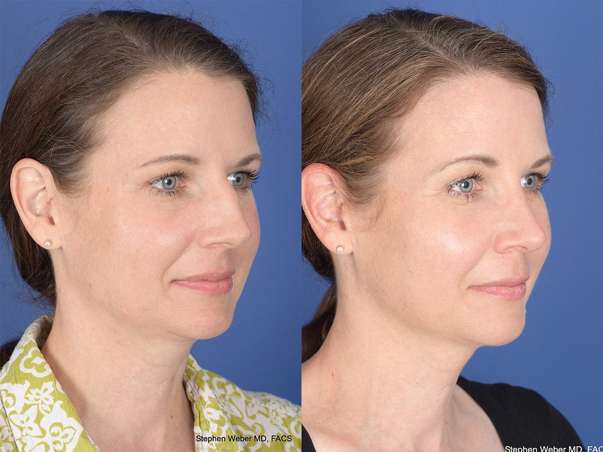 Cheek Implant Before and After | Weber Facial Plastic Surgery