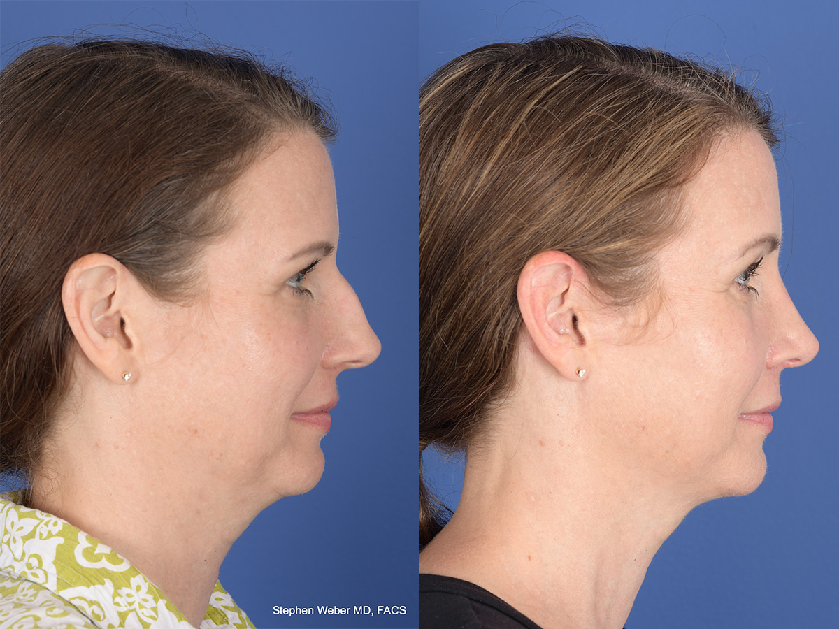 Cheek Implant Before and After | Weber Facial Plastic Surgery