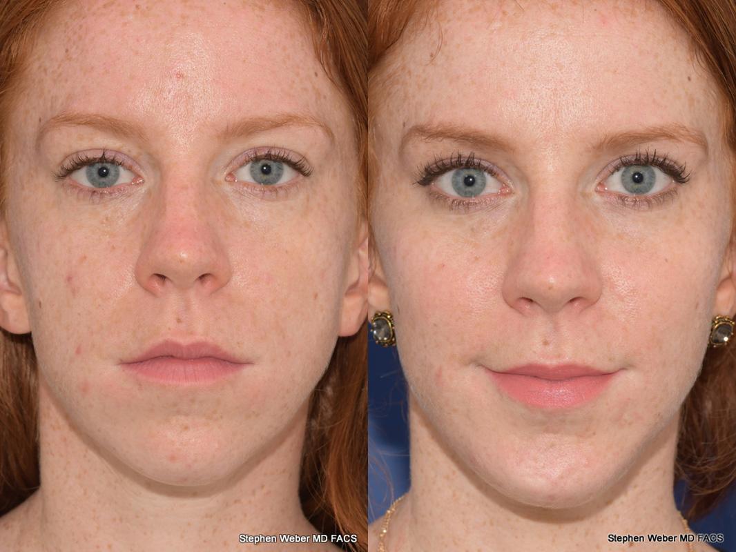 Cheek Implant Before and After | Weber Facial Plastic Surgery