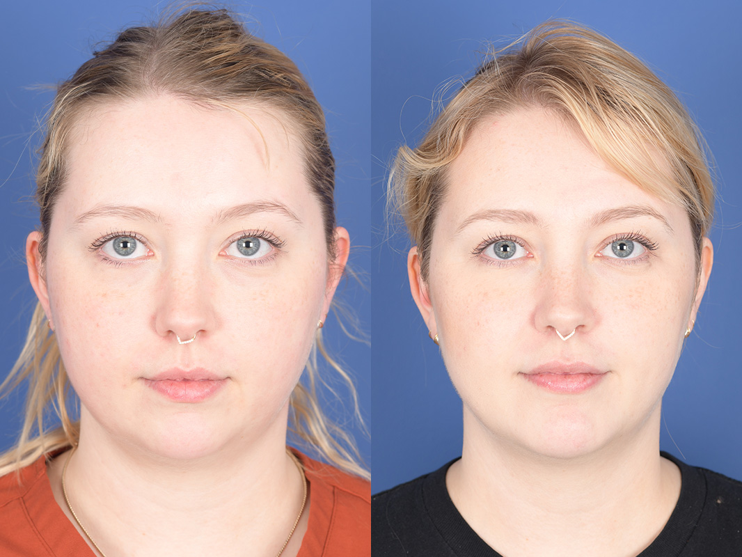 Chin Implant Before and After | Weber Facial Plastic Surgery