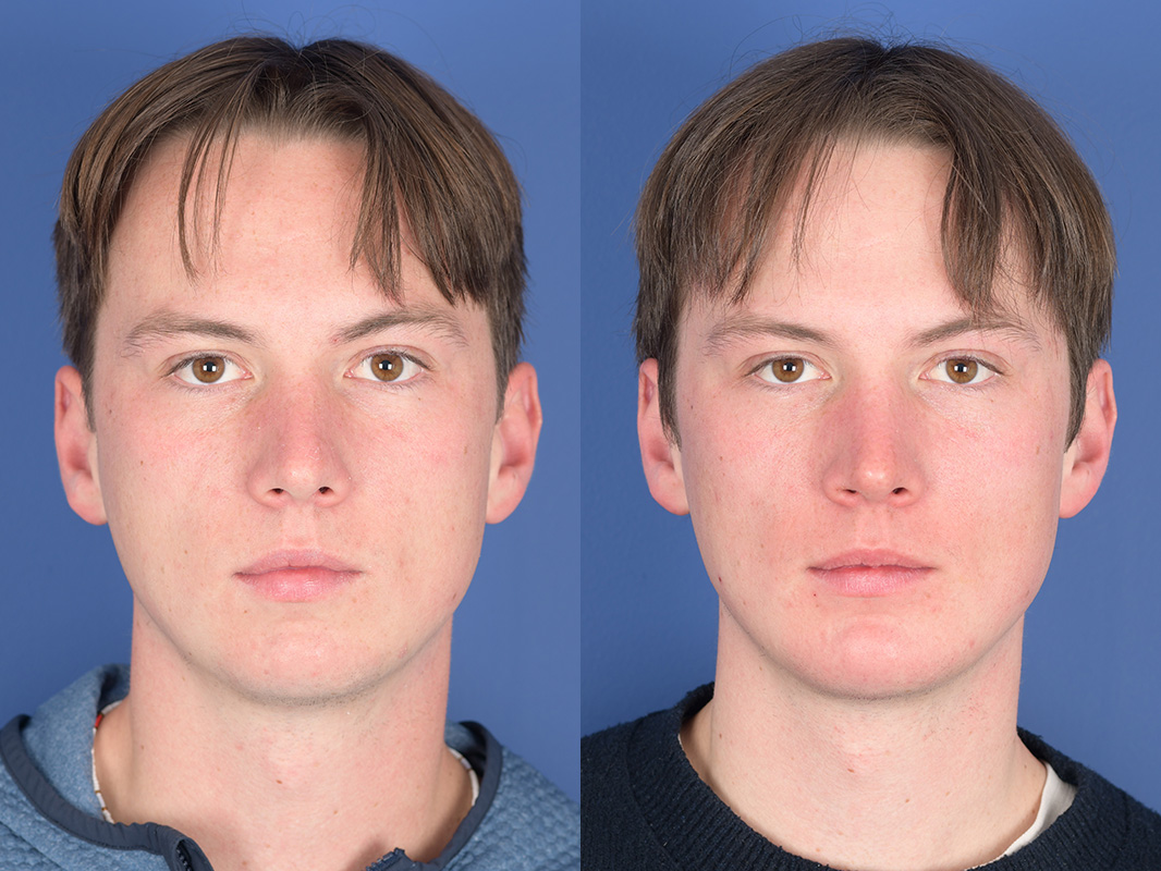 Chin Implant Before and After | Weber Facial Plastic Surgery