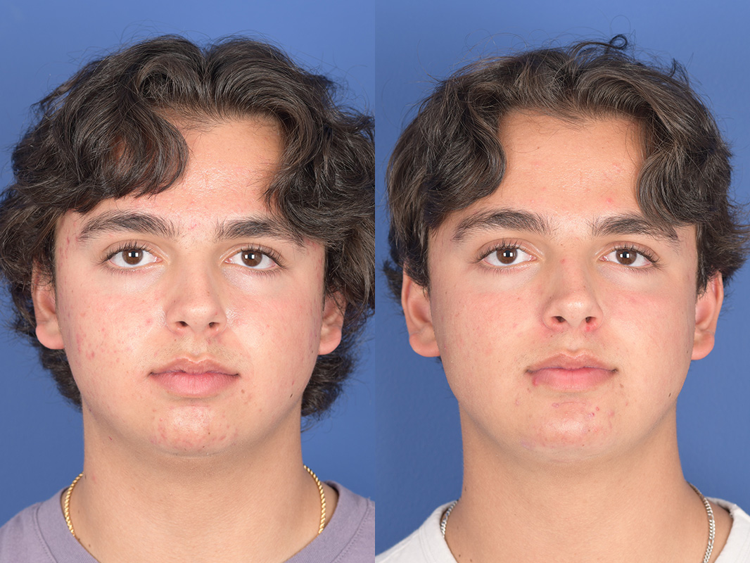 Chin Implant Before and After | Weber Facial Plastic Surgery