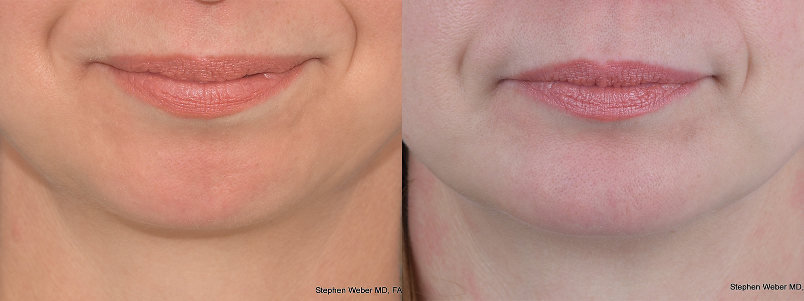 Chin Implant Before and After | Weber Facial Plastic Surgery
