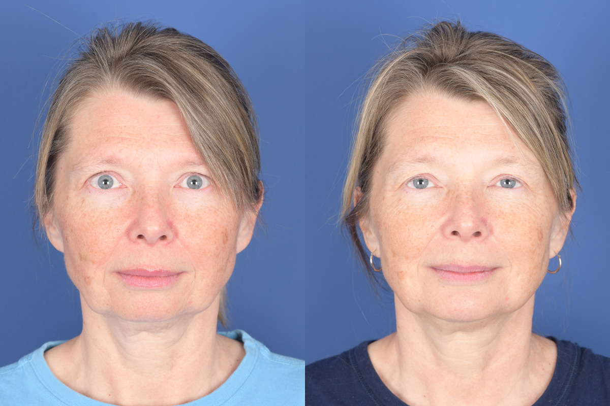 Chin Implant Before and After | Weber Facial Plastic Surgery