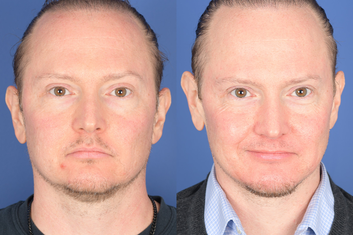 Chin Implant Before and After | Weber Facial Plastic Surgery