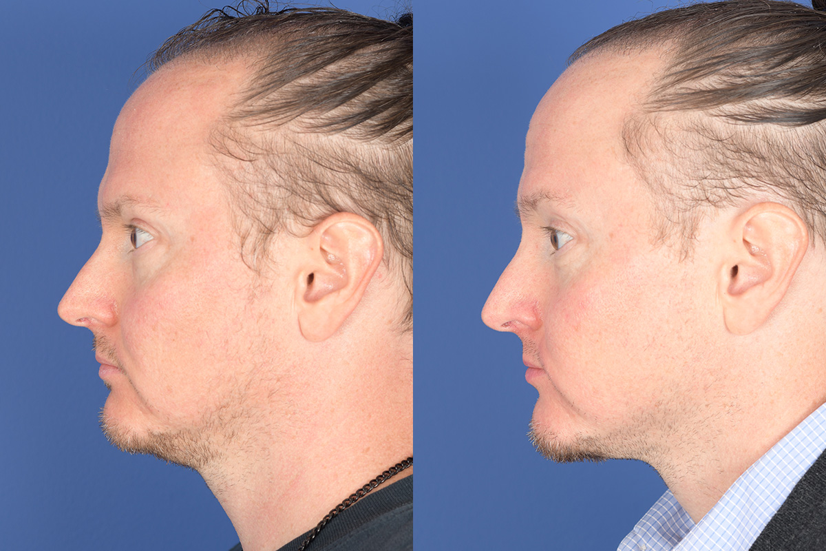 Chin Implant Before and After | Weber Facial Plastic Surgery