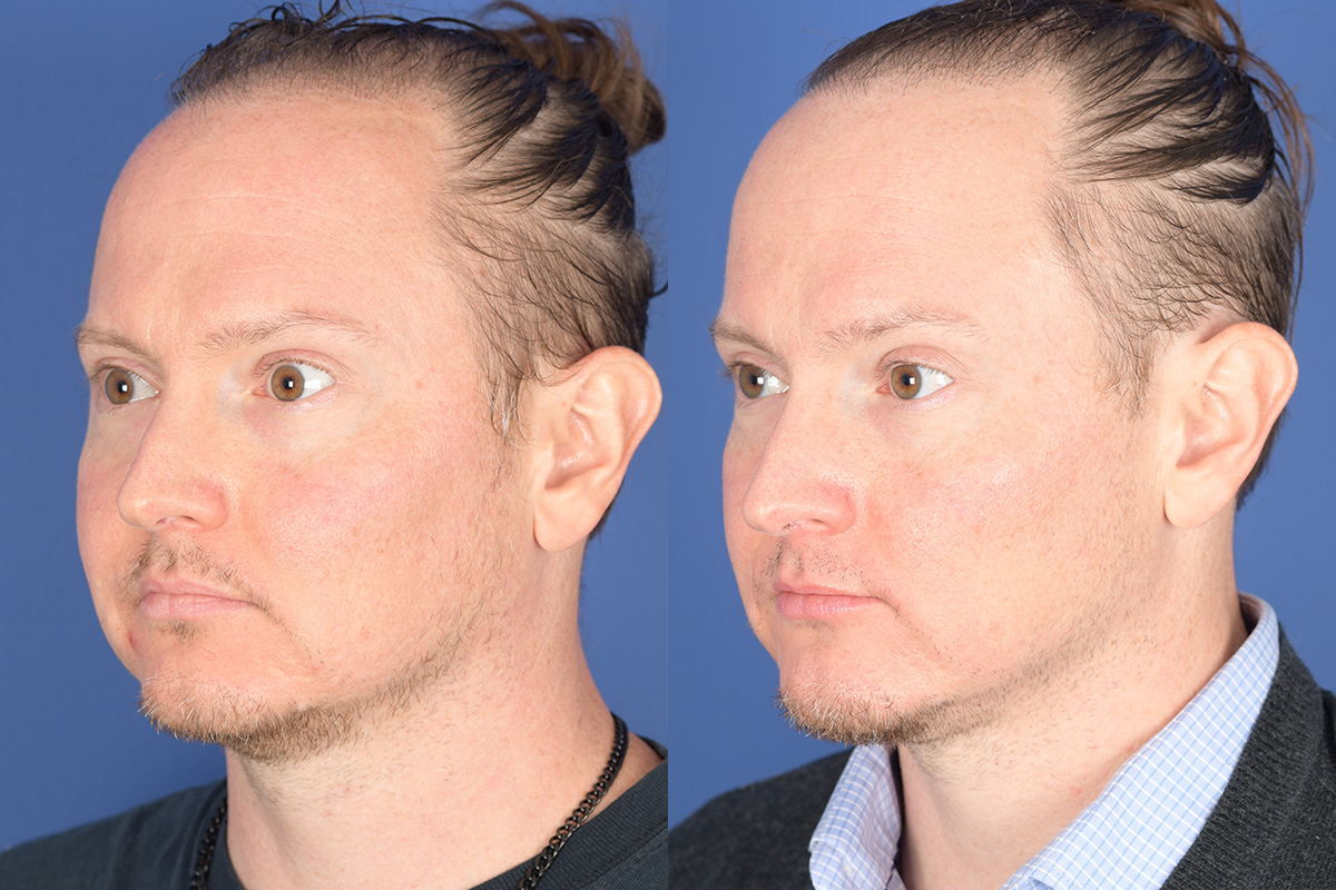 Chin Implant Before and After | Weber Facial Plastic Surgery