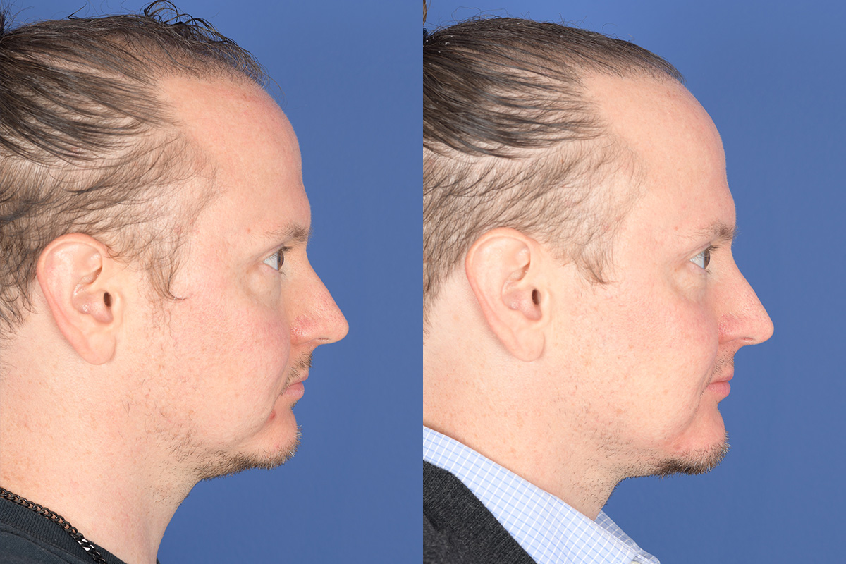 Chin Implant Before and After | Weber Facial Plastic Surgery