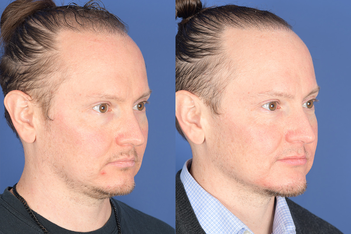 Chin Implant Before and After | Weber Facial Plastic Surgery