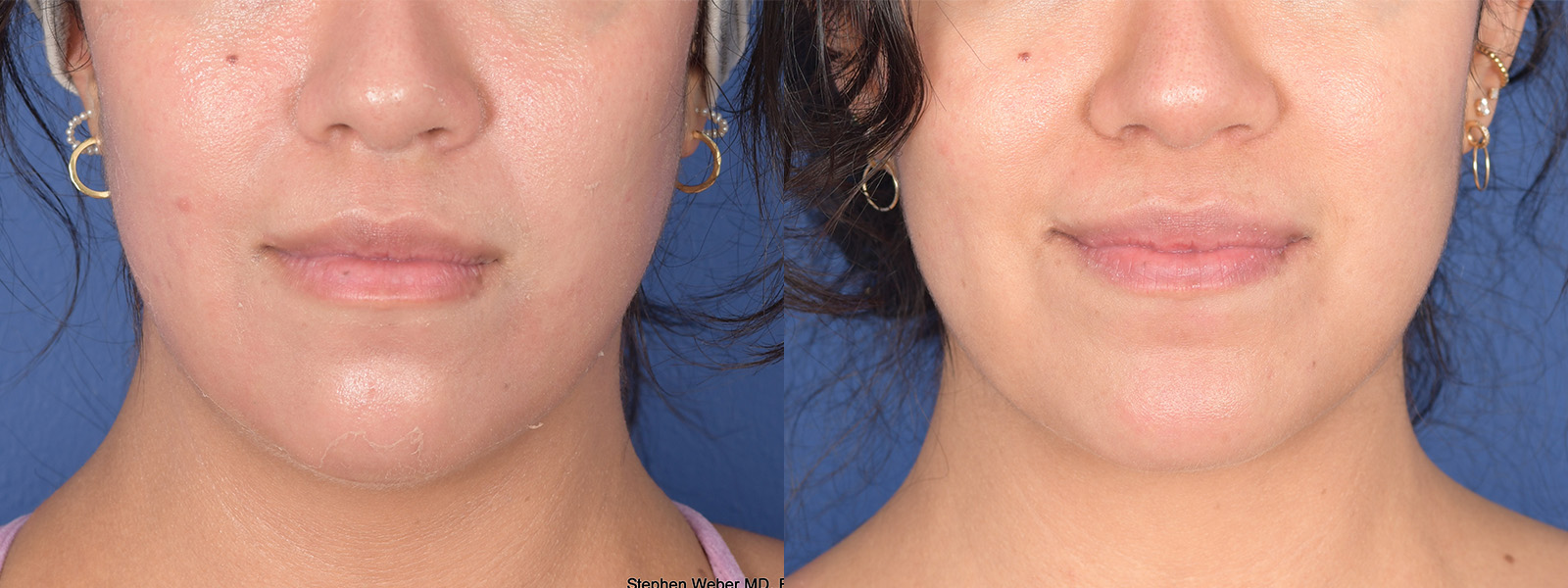 Chin Implant Before and After | Weber Facial Plastic Surgery