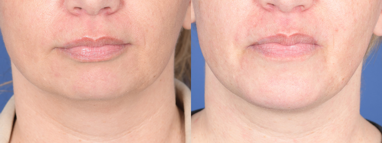 Chin Implant Before and After | Weber Facial Plastic Surgery