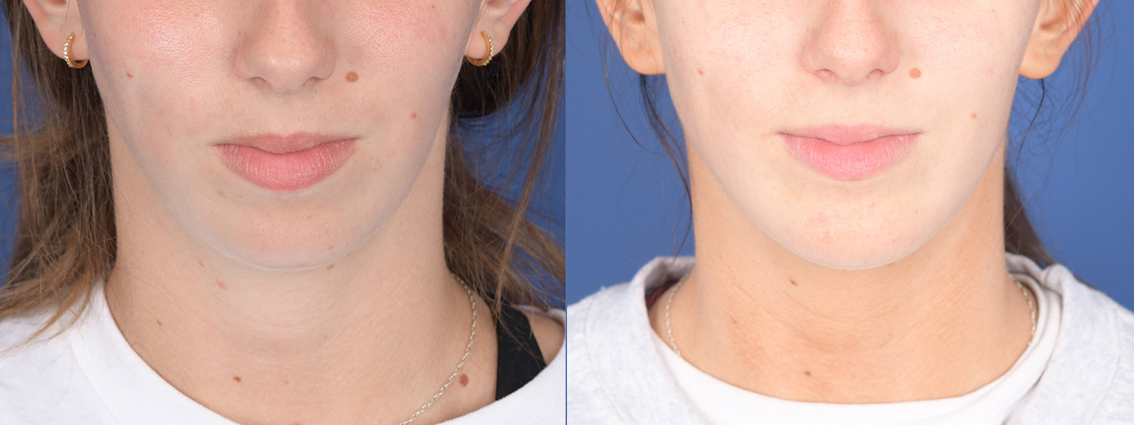 Chin Implant Before and After | Weber Facial Plastic Surgery