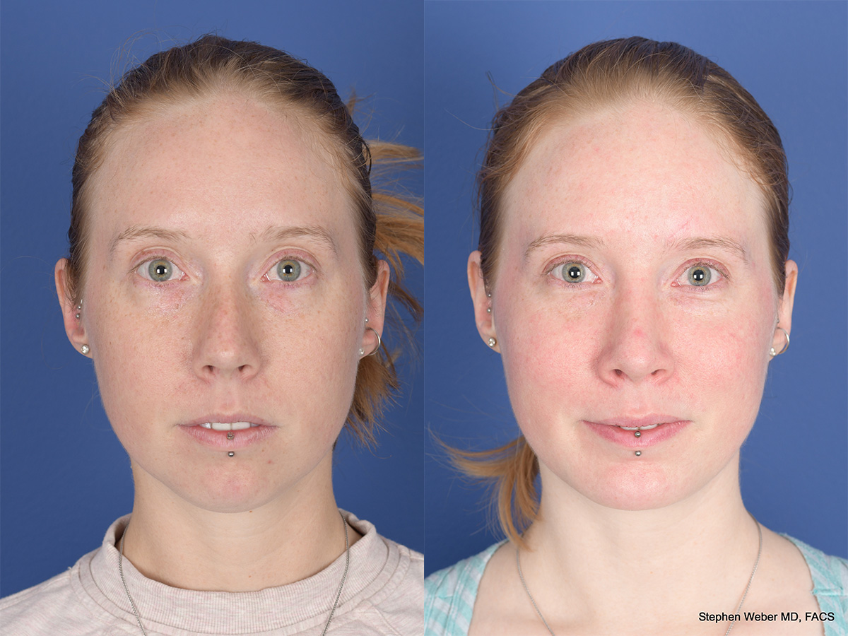 Chin Implant before and after, Frontal.