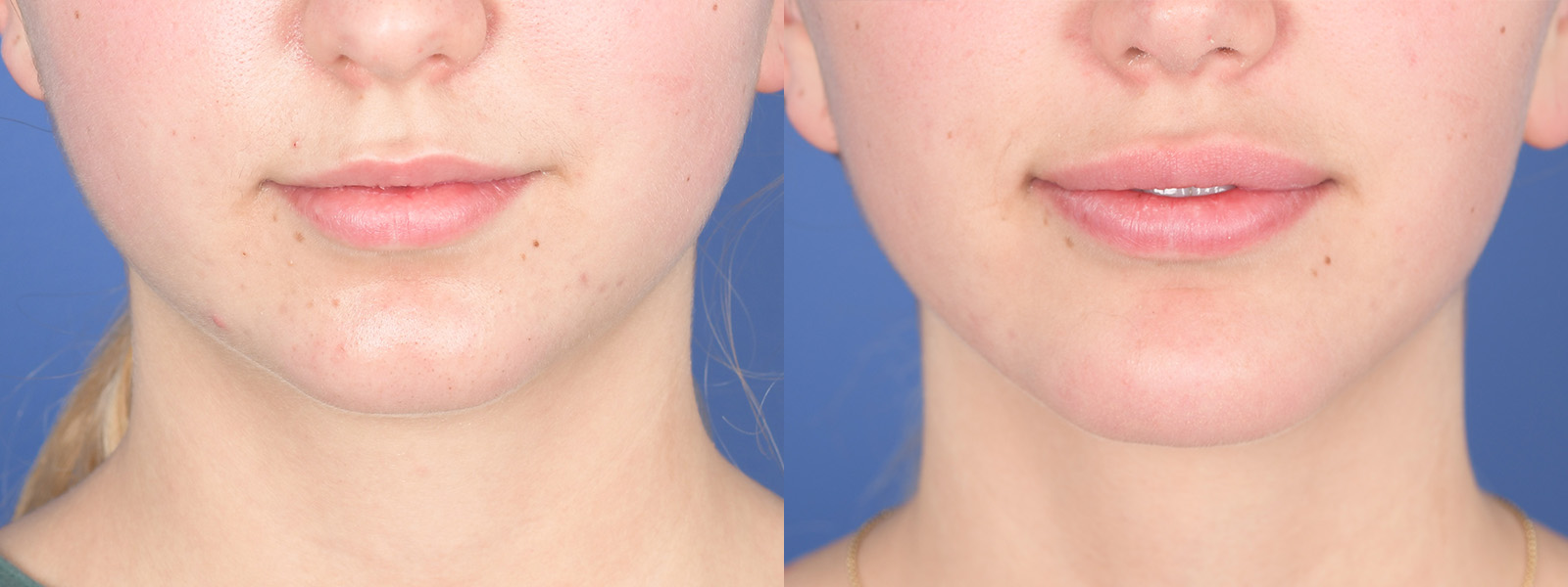 Chin Implant Before and After | Weber Facial Plastic Surgery