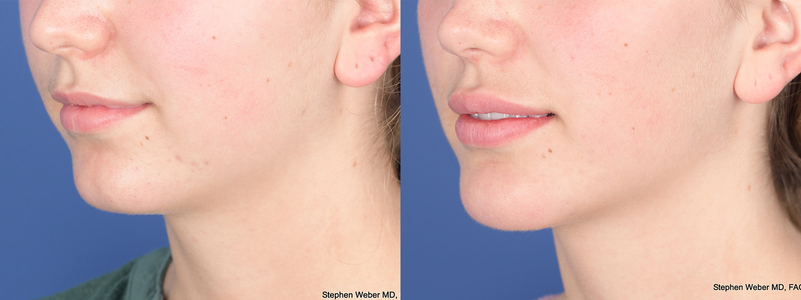 Chin Implant Before and After | Weber Facial Plastic Surgery