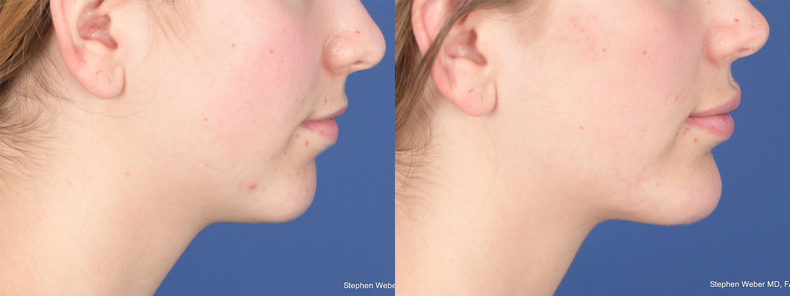 Chin Implant Before and After | Weber Facial Plastic Surgery