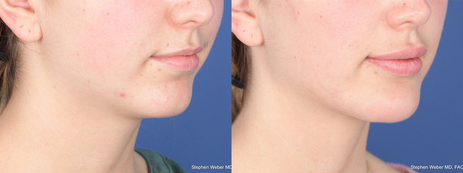 Chin Implant Before and After | Weber Facial Plastic Surgery