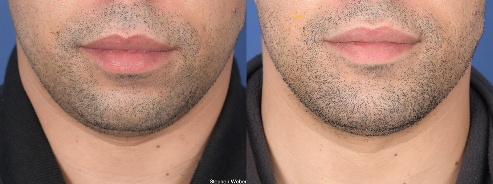 Chin Implant Before and After | Weber Facial Plastic Surgery