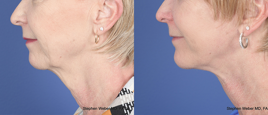 Chin Implant Before and After | Weber Facial Plastic Surgery