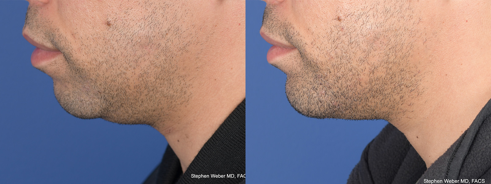 Chin Implant Before and After | Weber Facial Plastic Surgery
