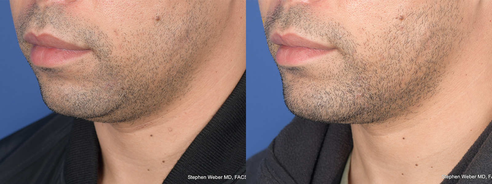 Chin Implant Before and After | Weber Facial Plastic Surgery