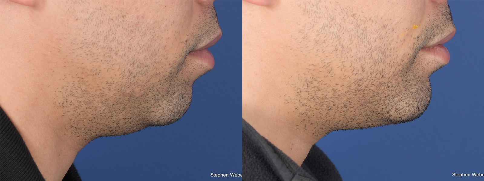 Chin Implant Before and After | Weber Facial Plastic Surgery
