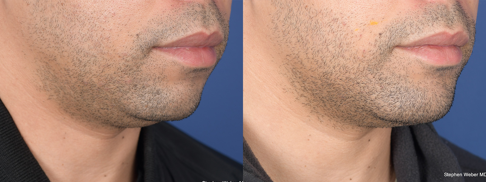 Chin Implant Before and After | Weber Facial Plastic Surgery
