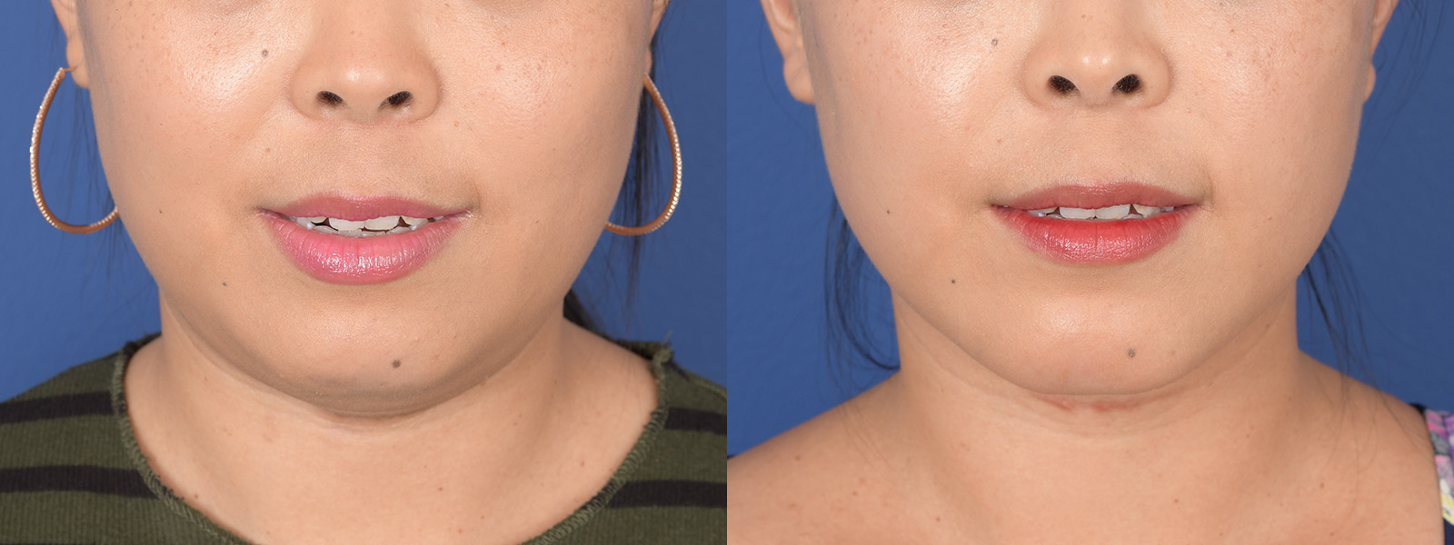 Chin Implant Before and After | Weber Facial Plastic Surgery