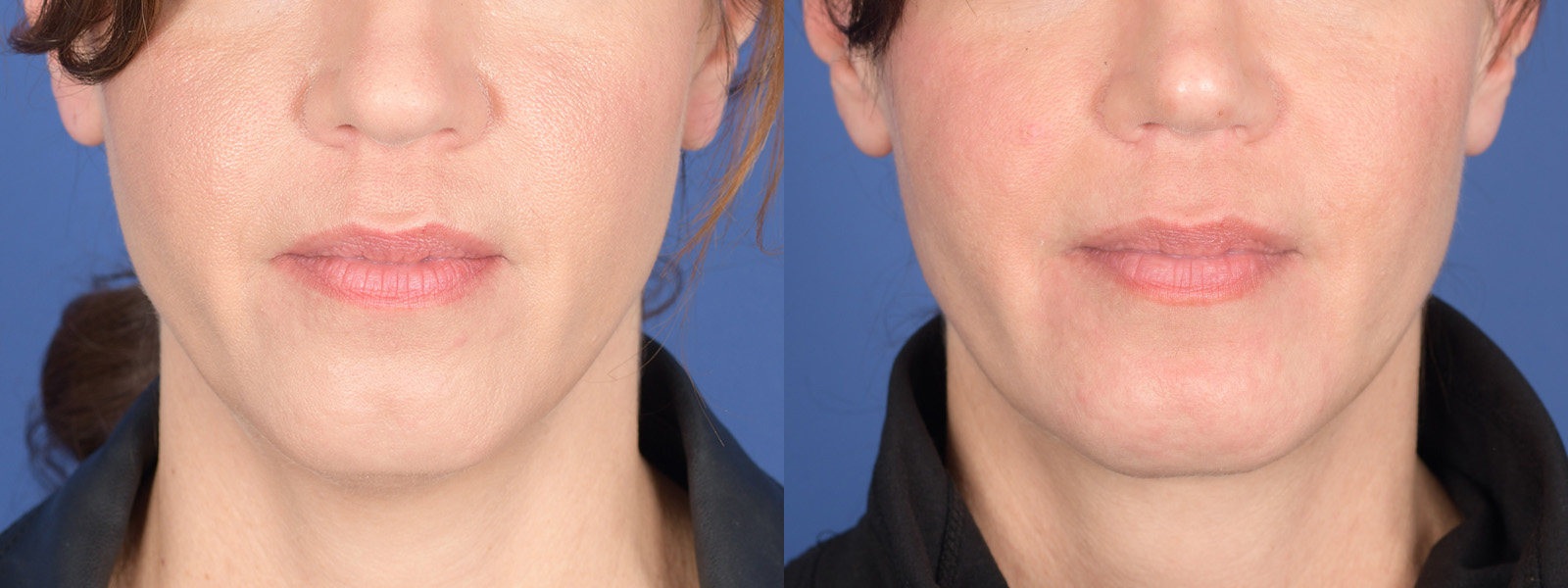 Chin Implant Before and After | Weber Facial Plastic Surgery