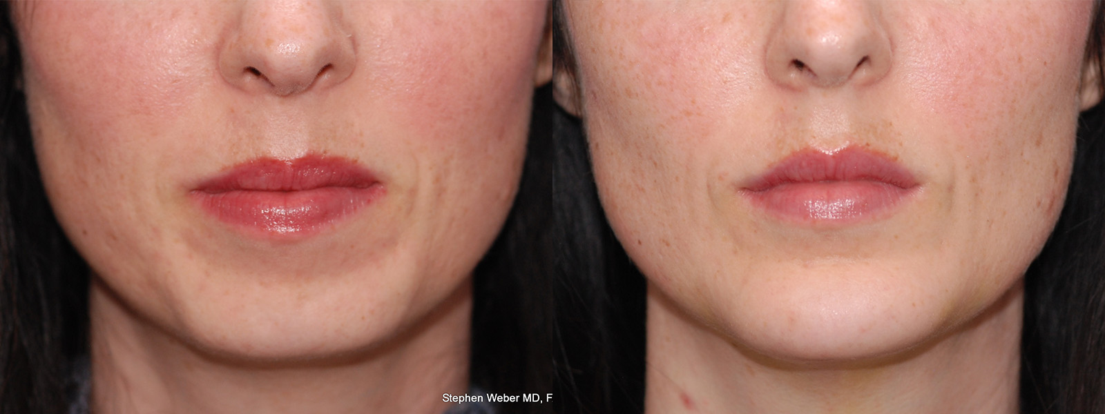 Chin Implant Before and After | Weber Facial Plastic Surgery