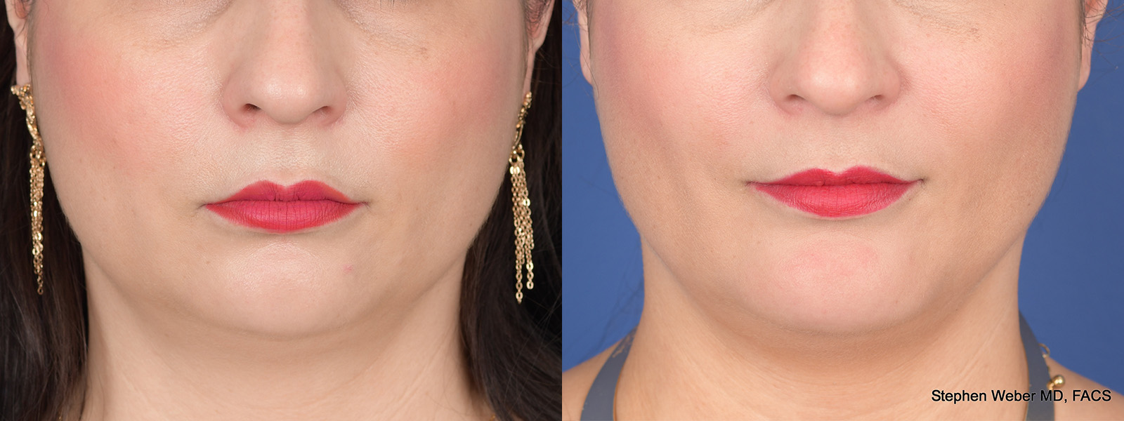 Chin Implant Before and After | Weber Facial Plastic Surgery