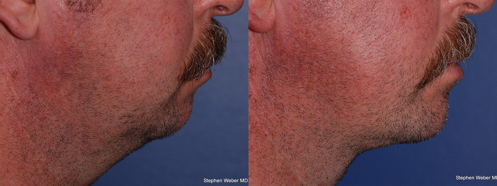 Chin Implant Before and After | Weber Facial Plastic Surgery