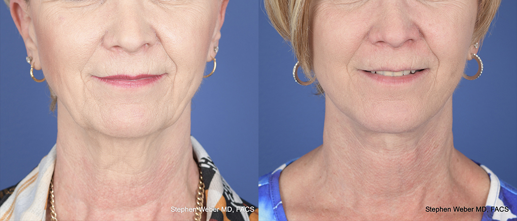 Chin Implant Before and After | Weber Facial Plastic Surgery