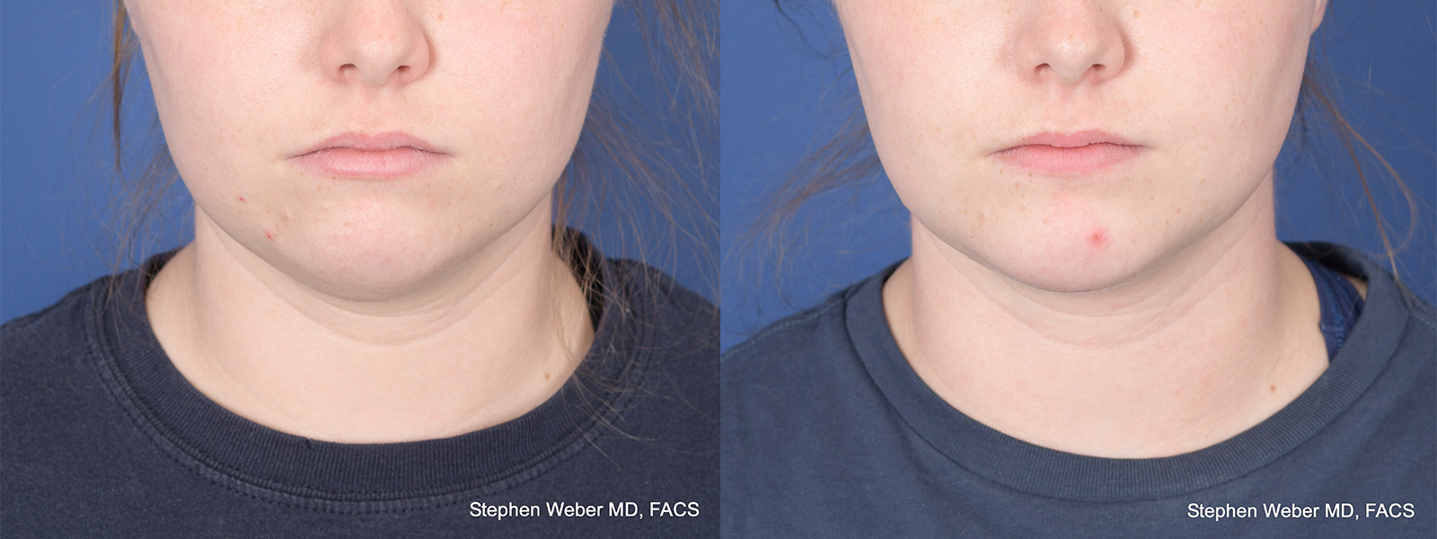 Chin Implant Before and After | Weber Facial Plastic Surgery