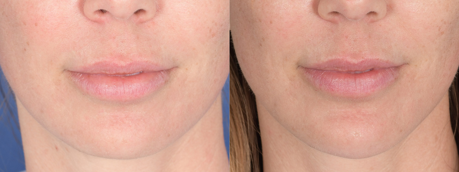 Chin Implant Before and After | Weber Facial Plastic Surgery