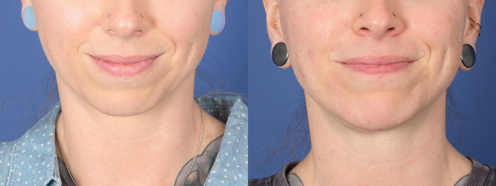 Chin Implant Before and After | Weber Facial Plastic Surgery