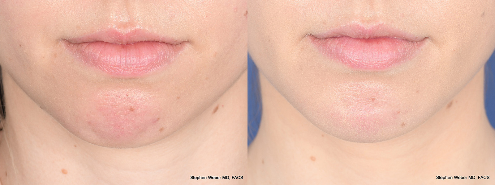 Chin Implant Before and After | Weber Facial Plastic Surgery