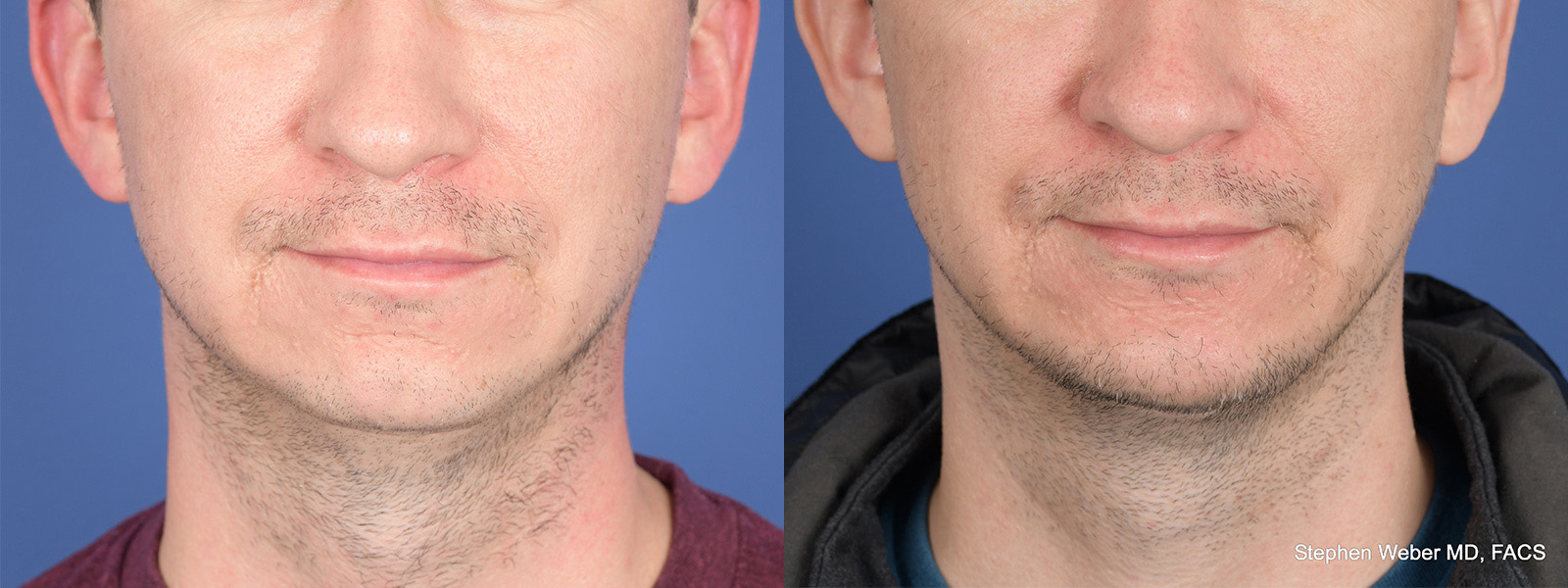 Chin Implant Before and After | Weber Facial Plastic Surgery