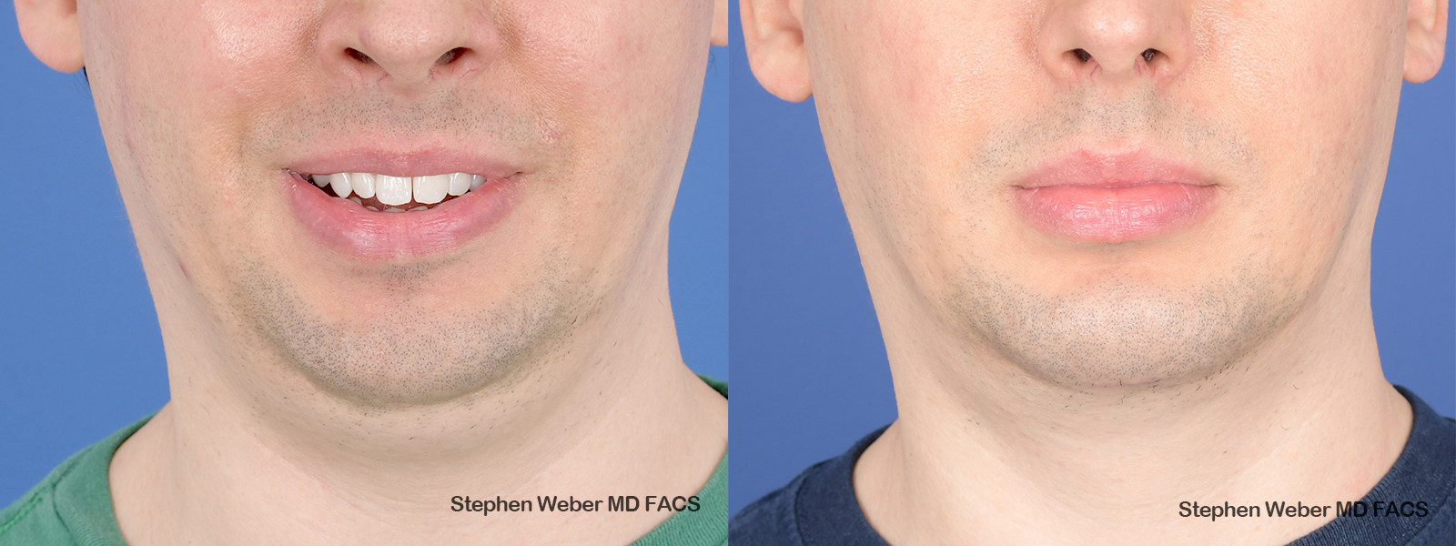 Chin Implant Before and After | Weber Facial Plastic Surgery
