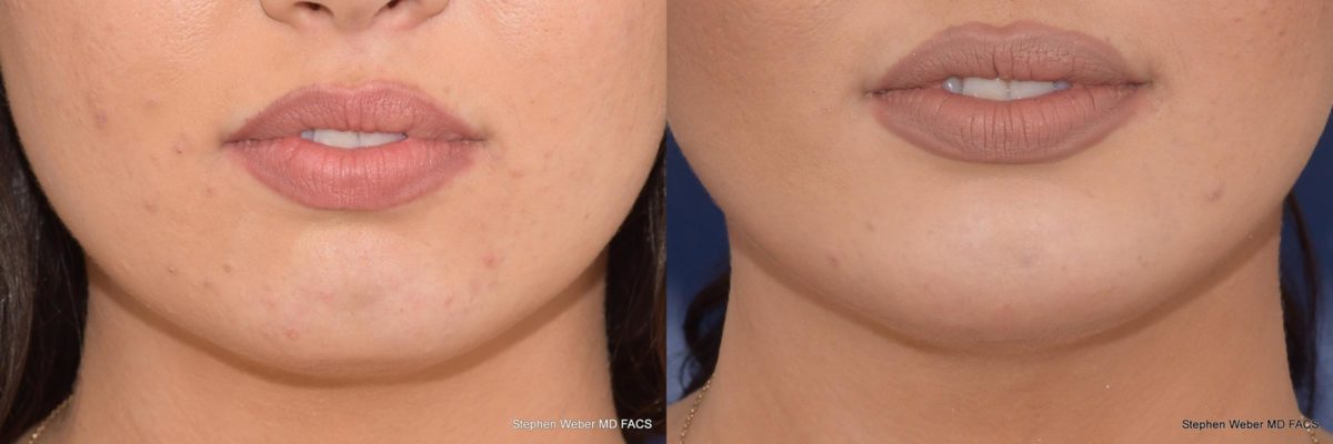 Chin Implant Before and After | Weber Facial Plastic Surgery